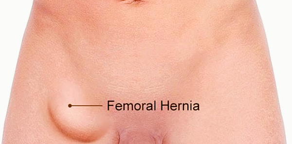 Femoral hernia •